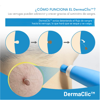 DermaClic™ | Kit eliminador de verrugas