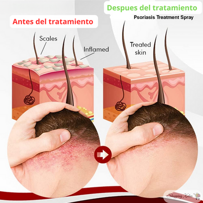 Psoraclear™ - Fórmula activa para el alivio rápido de la psoriasis