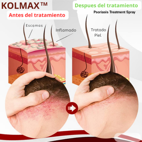 PielLibre™ 2x1 – Spray Anti-Psoriasis