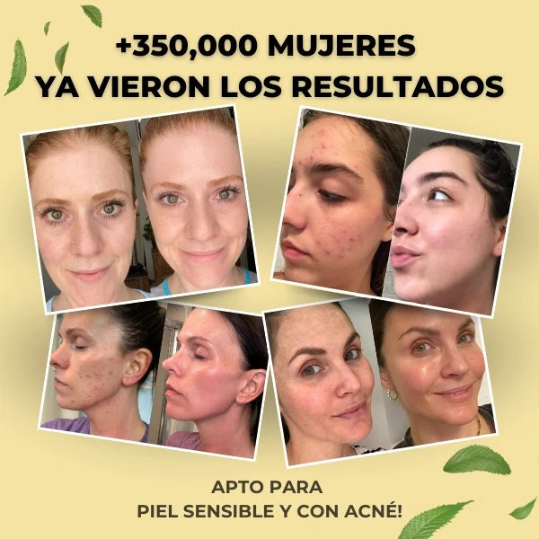 LumiSkin™ - Restaura Tu Juventud, Sin Agujas